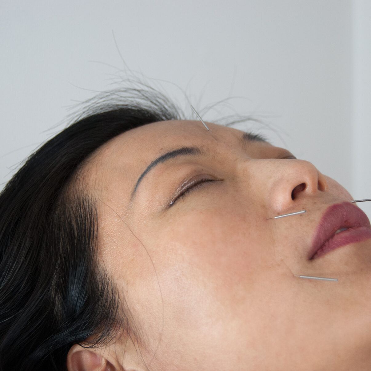 TCM München, Naturheilpraxis für Traditionelle Chinesische Medizin und Akupunktur 18 Akupunktur